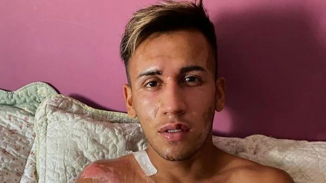 Futbolista de Vélez Sarsfield sufrió graves quemaduras con aceite hirviendo