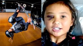 Skater de 11 años sufrió severo accidente durante un entrenamiento