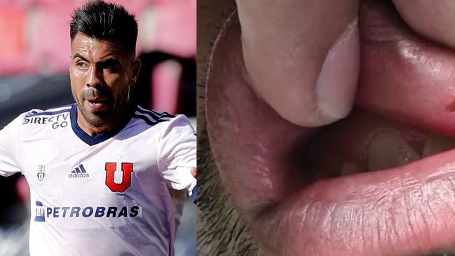 Gonzalo Espinoza mostró cómo quedó su labio tras codazo que le significó una amarilla