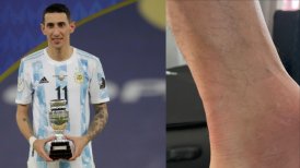 "Así siguió jugando": Esposa mostró el tobillo de Angel Di María tras la final de Copa América