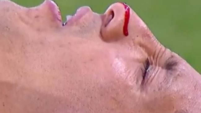 Jugador de River Plate sufrió una fractura en su rostro en el clásico ante Boca Juniors